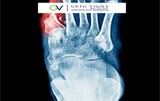 Amputation malpractice - image of x ray