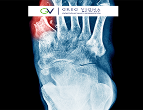 Vigna Law Group: A Medicolegal Perspective of Phantom Limb Pain After Traumatic Amputation