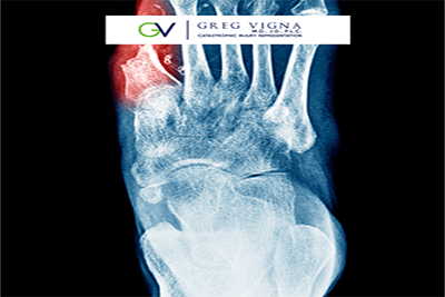 Amputation malpractice - image of x ray