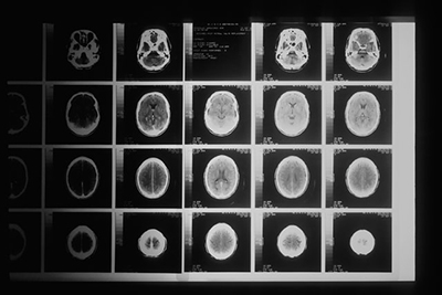 Black and white images of a brain CT scan