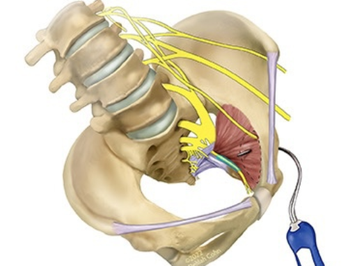 Vigna Law Group: Transobturator Slings – Man-made Obturator and Pudendal Neuralgia