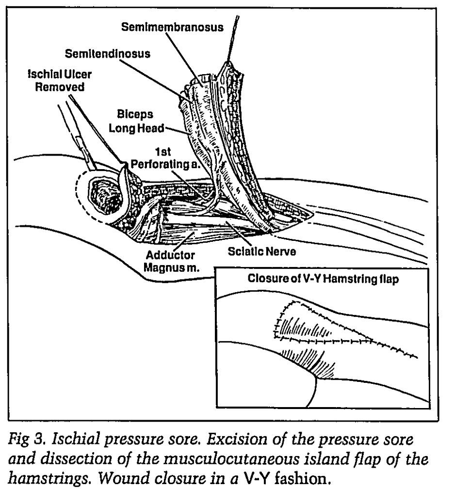 Ischial decubitus ulcer: Hamstring flap/Gluteus maximus flap