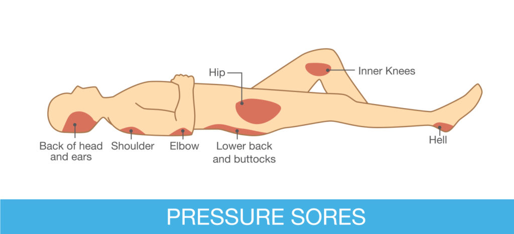 A helpful graphic showing possible locations of pressure sores.