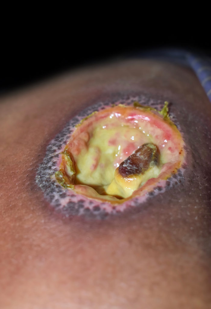 Grade III, possible Grade IV decubitus ulcer that has necrotic tissue and might be infected