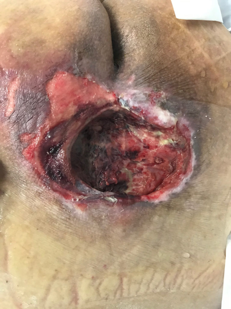 Grade IV sacral decubitus ulcer and this wound not compatible with life