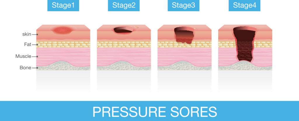 The stages of Pressure sores an infographic.
