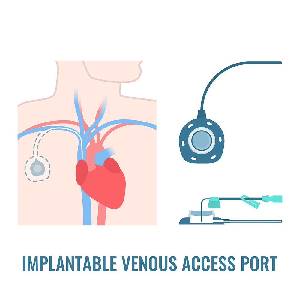 PowerPort / Venous Catheter - Vigna Law Group
