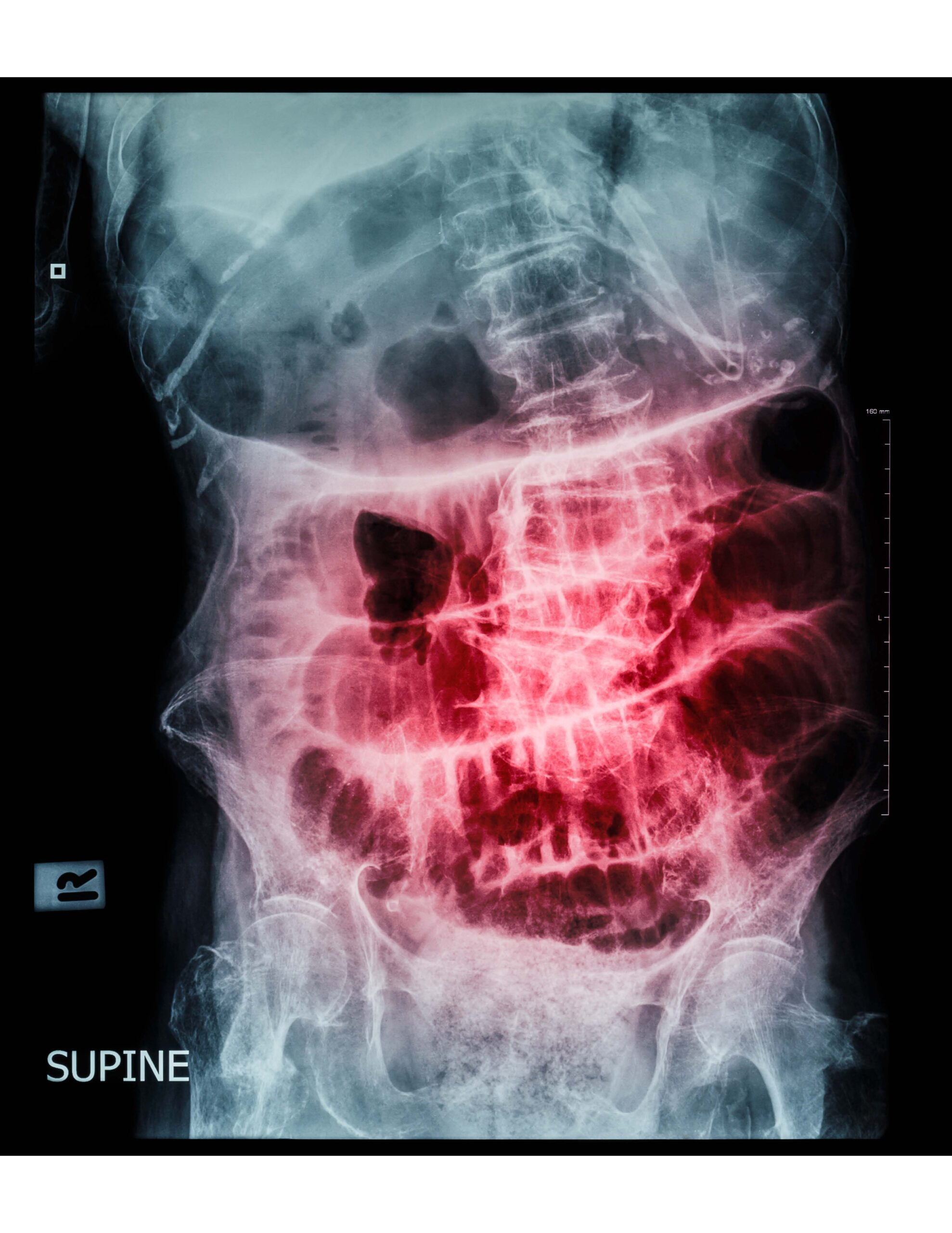 film x-ray abdomen