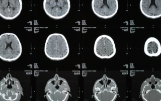 brains on xray film