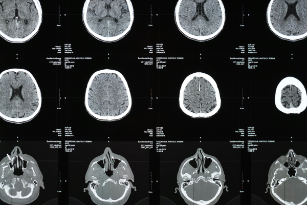 brains on xray film