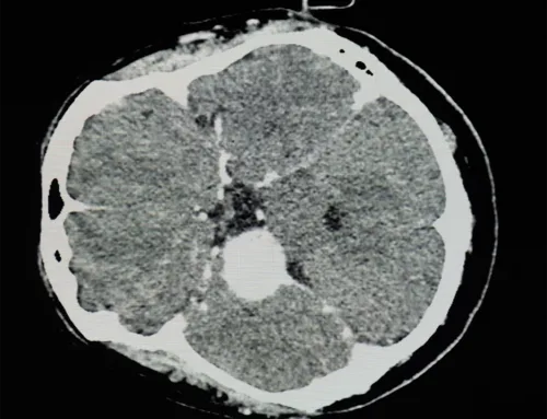 Depo-Provera and Meningioma: Pathology Examination and Progesterone Receptor Expression