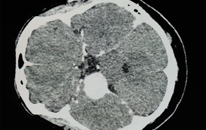 Meningioma