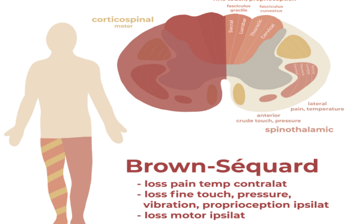 Brown-Sequard Syndrome