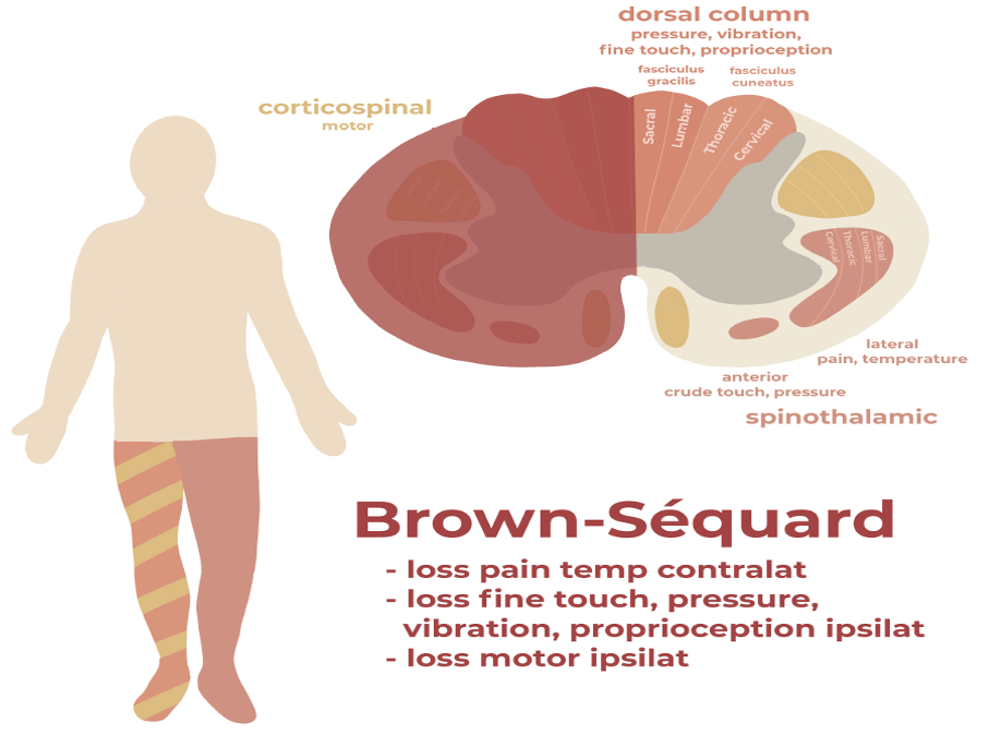 Brown-Sequard Syndrome