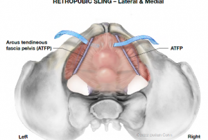 Retropubic Sling diagram