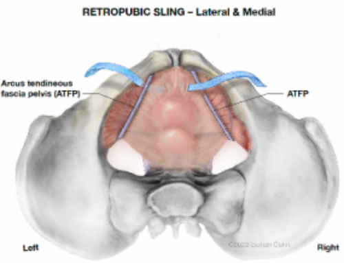 Mid-urethral Sling Complications: Early Complete Mesh Removal for Groin Pain