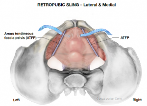 Retropubic Sling diagram